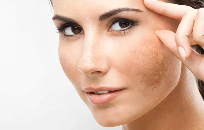 لکه قهوه ای روی پوست